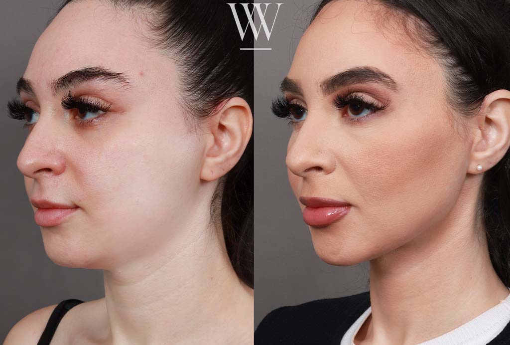 Neck liposuction before and after results of a Washington DC patient