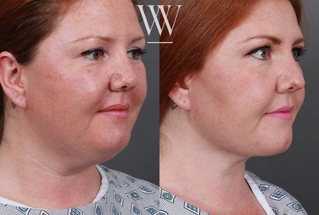 Neck liposuction before and after in Washington DC