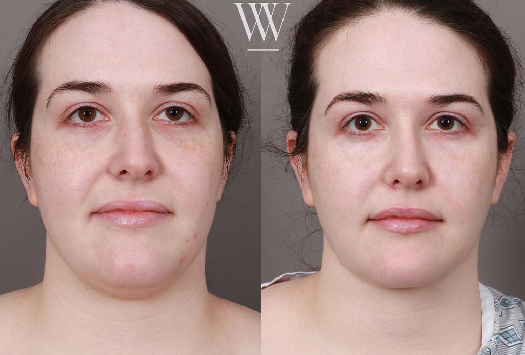 Before and after neck liposuction results in Washington DC