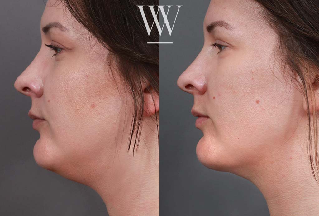 Before and after neck liposuction on a Washington DC woman