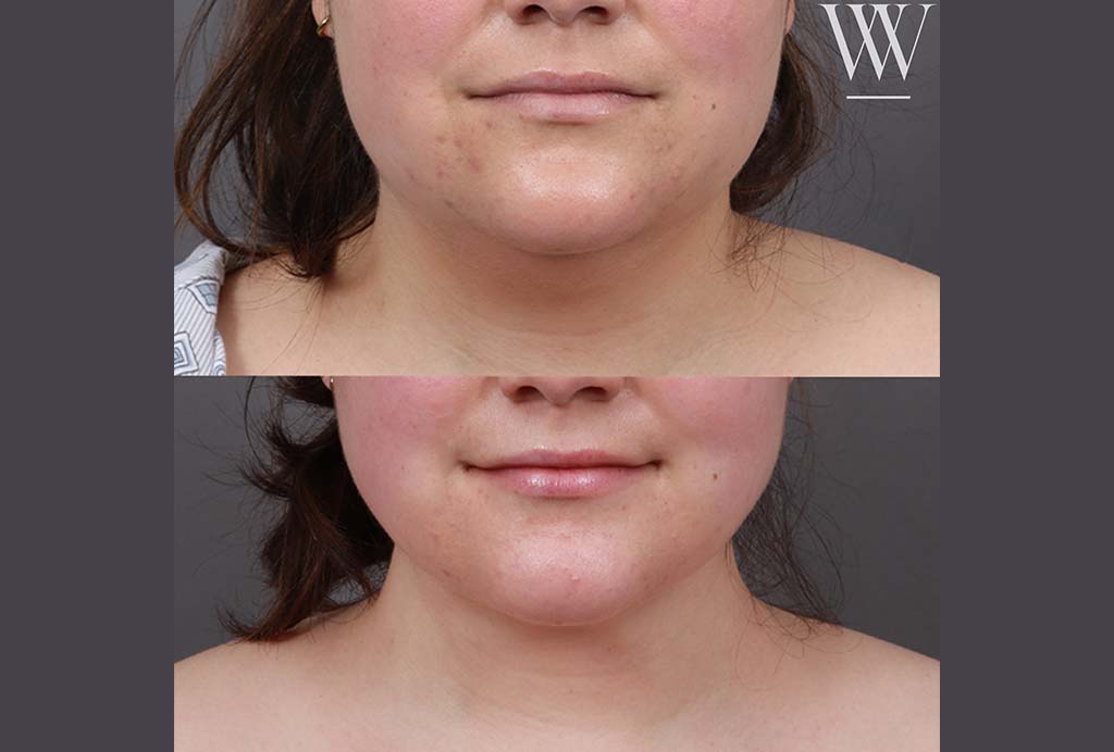 Before and after results of a Washington DC neck liposuction patient