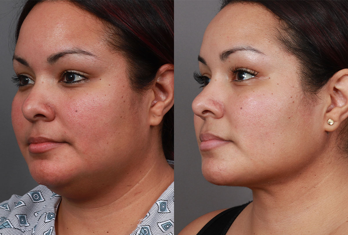 patient before and after neck liposuction in Washington, DC