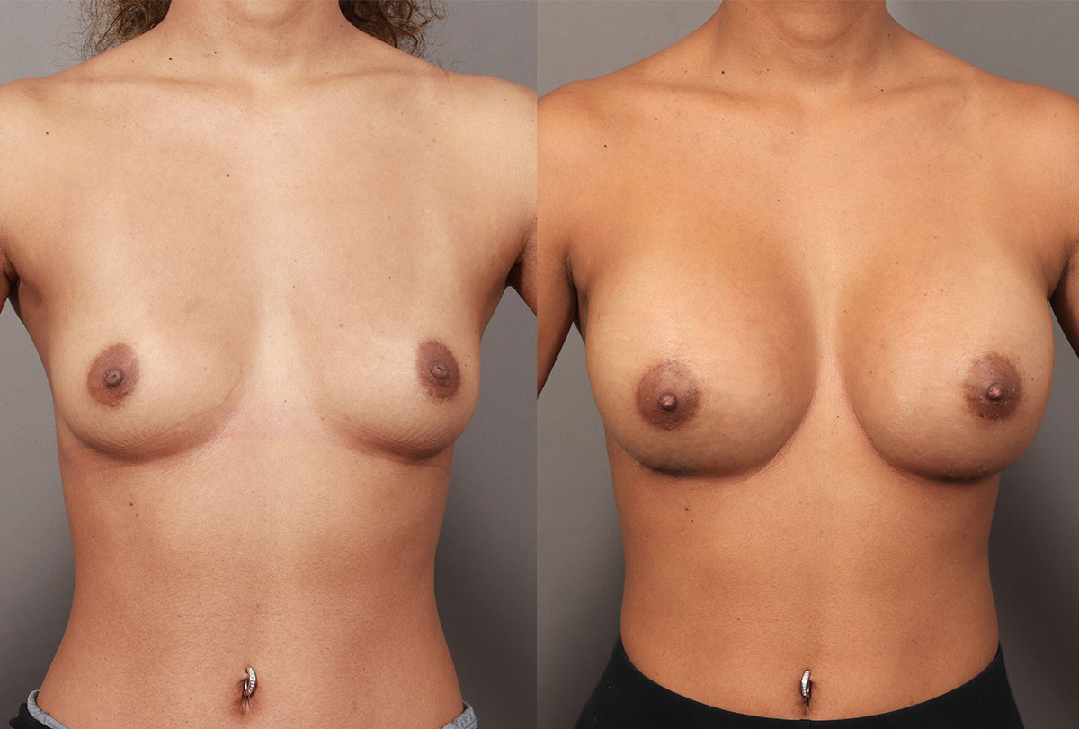 Before and after results of a breast augmentation in Washington DC.