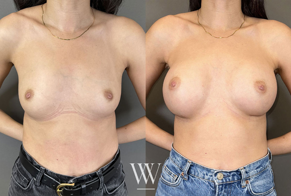Before and after photos of breast augmentation results in Washington, DC.