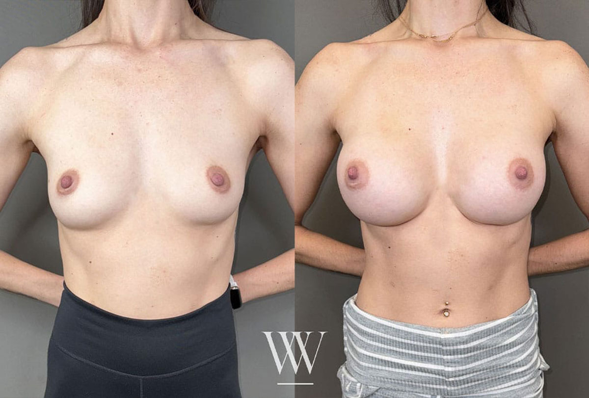 Breast augmentation transformation shown in before and after images in Washington DC patient.