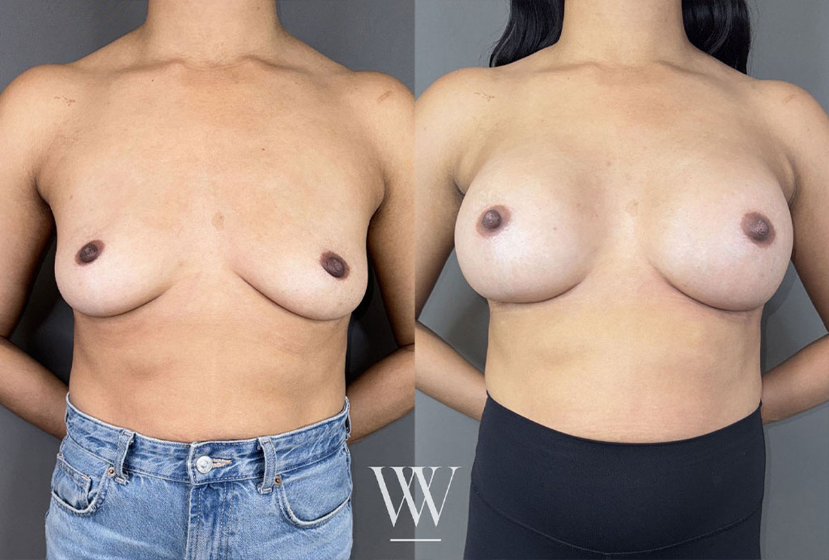 Patient before and after images following breast augmentation in Washington, DC.