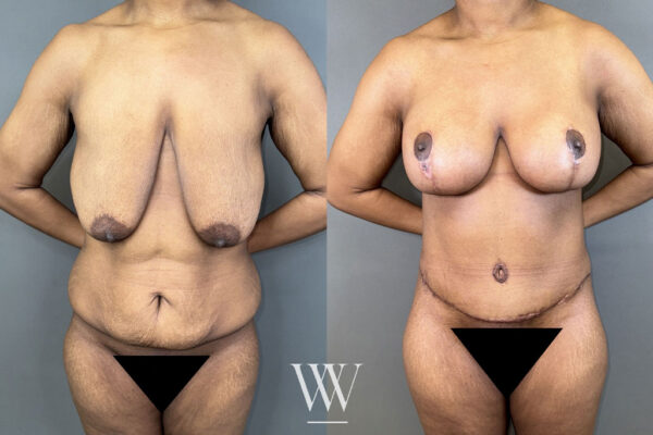 Before and after images show the results of a tummy tuck in Washington, DC.