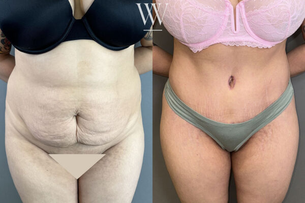 A woman shows her results after tummy tuck surgery in Washington, DC.