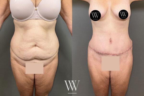 Before and after results of a tummy tuck in Washington, DC.