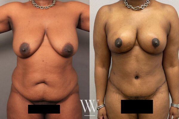 A woman's before and after results of tummy tuck surgery in Washington, DC.